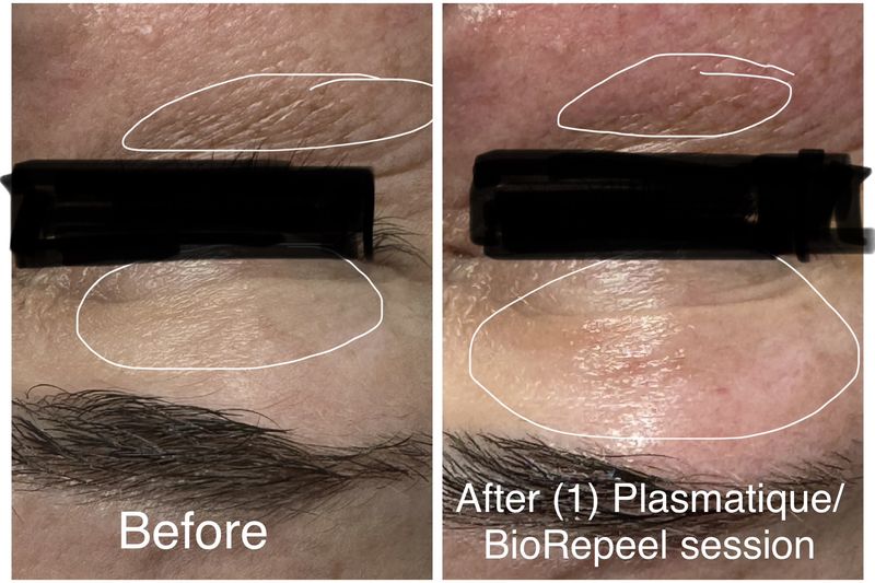 Before and after: brow and upper eyelid. After one Plasmatique and BioRePeel session.