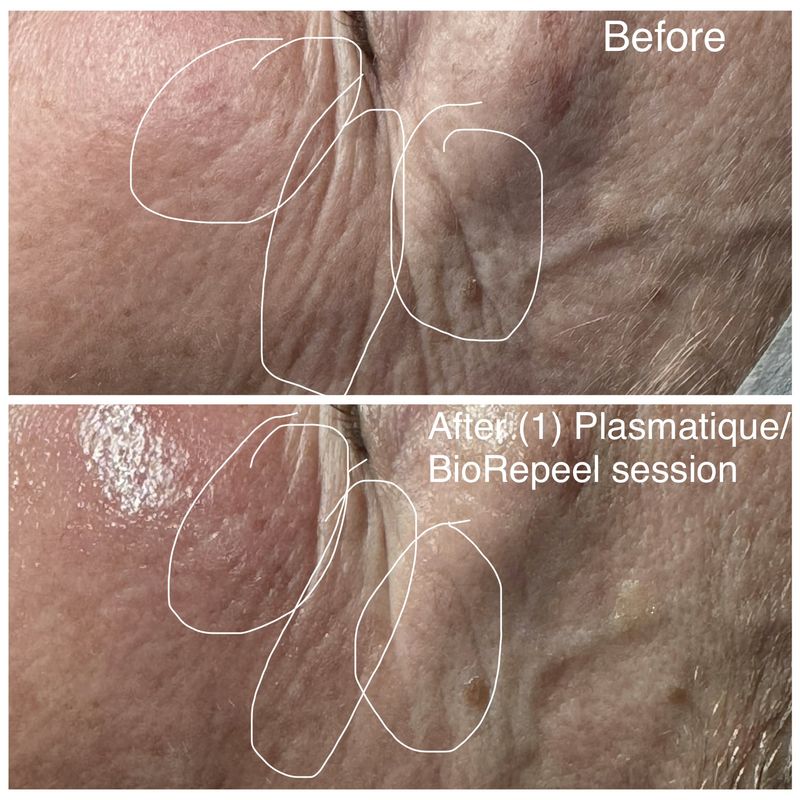 Before and after: cheek lines. After one Plasmatique and BioRePeel session.