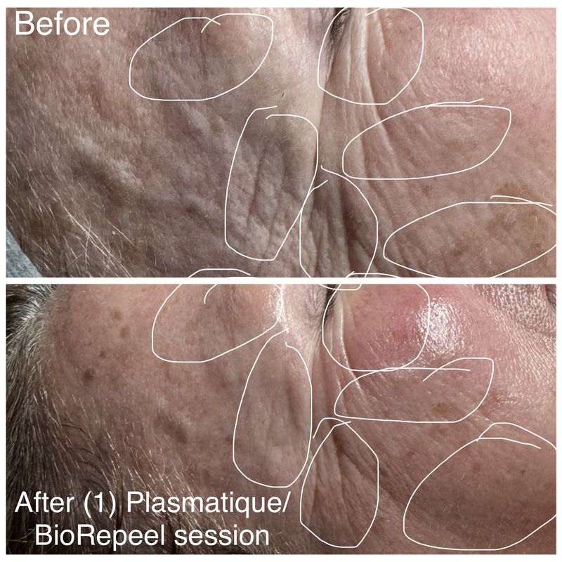 Before and after: cheek texture. After one Plasmatique and BioRePeel session.