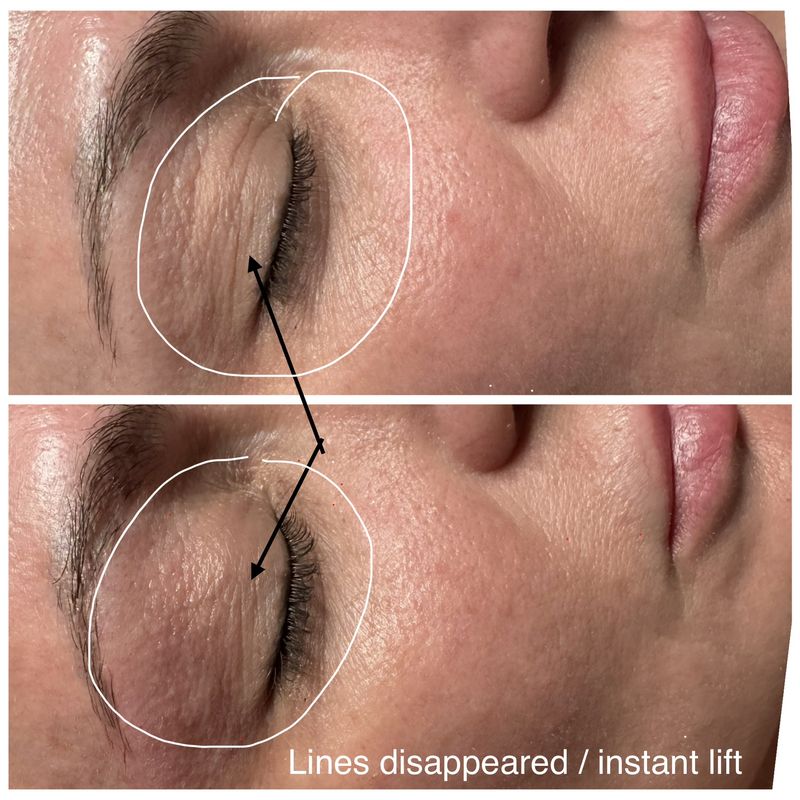 Before and after: eye area. Instant lift.