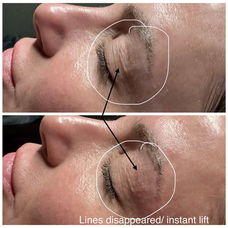 Before and after: eye area, side view. Instant lift.